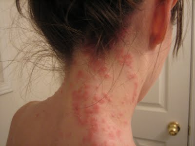 Skin Rash & Celiac Disease| Gluten Free Therapeutics